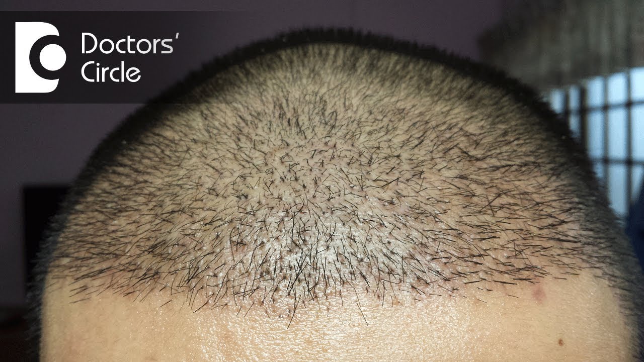 How long does it take for hair to grow after a hair transplant? - Dr. Madan Kumar BJ