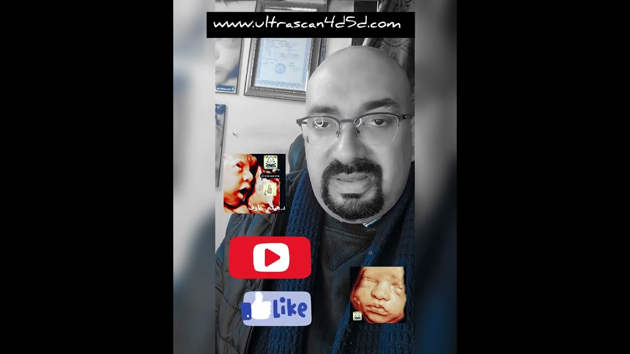 لو حامل و خايفه من متلازمه داون لازم  تشوفي الفيديو ده