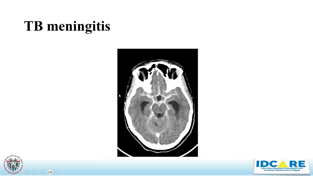 5- CNS Infections