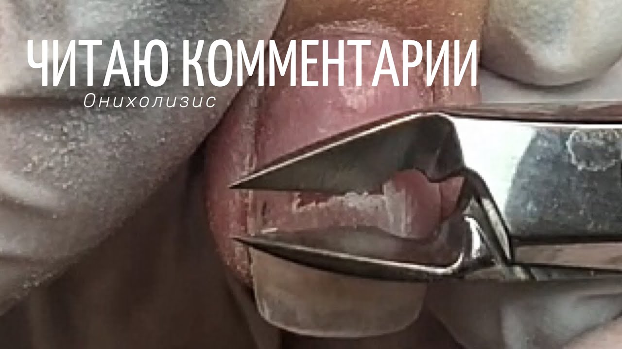 ОНИХОЛИЗИС. Положительная динамика