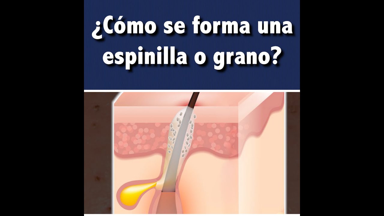 &iquest;C&oacute;mo se forma una espinilla o grano? 👩🏻&zwj;⚕️l Dra. Pau Z&uacute;&ntilde;iga CLIPS