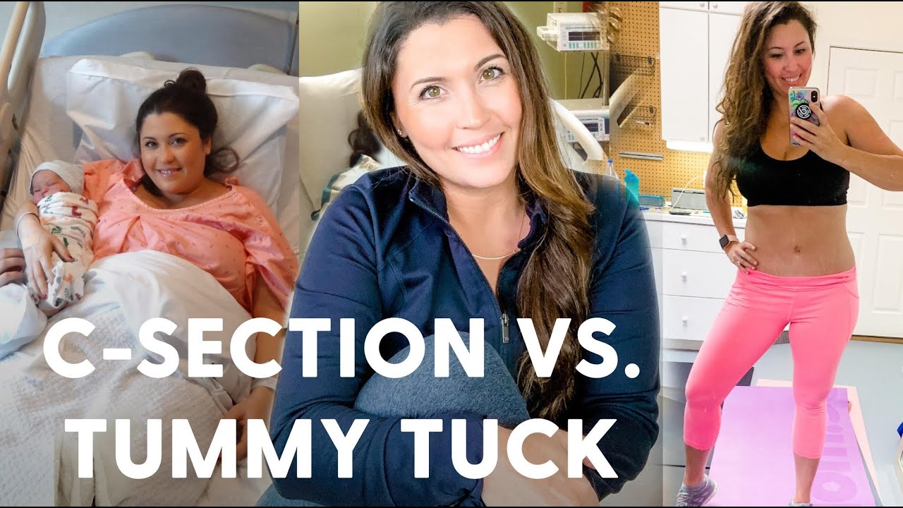 How a Tummy Tuck Compares to a C-Section (Pain and Recovery Post-op)