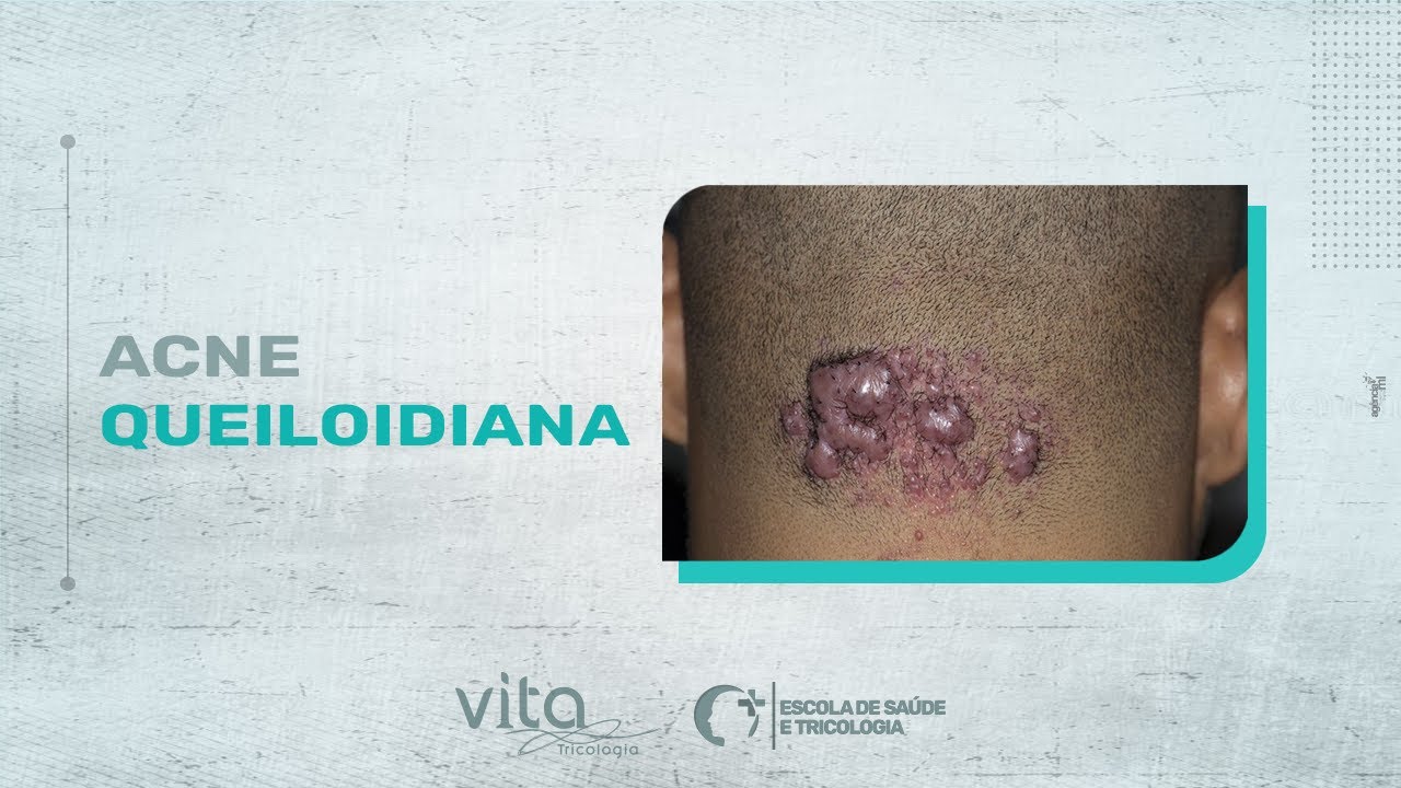 ACNE QUELOIDIANA | VITA TRICOLOGIA