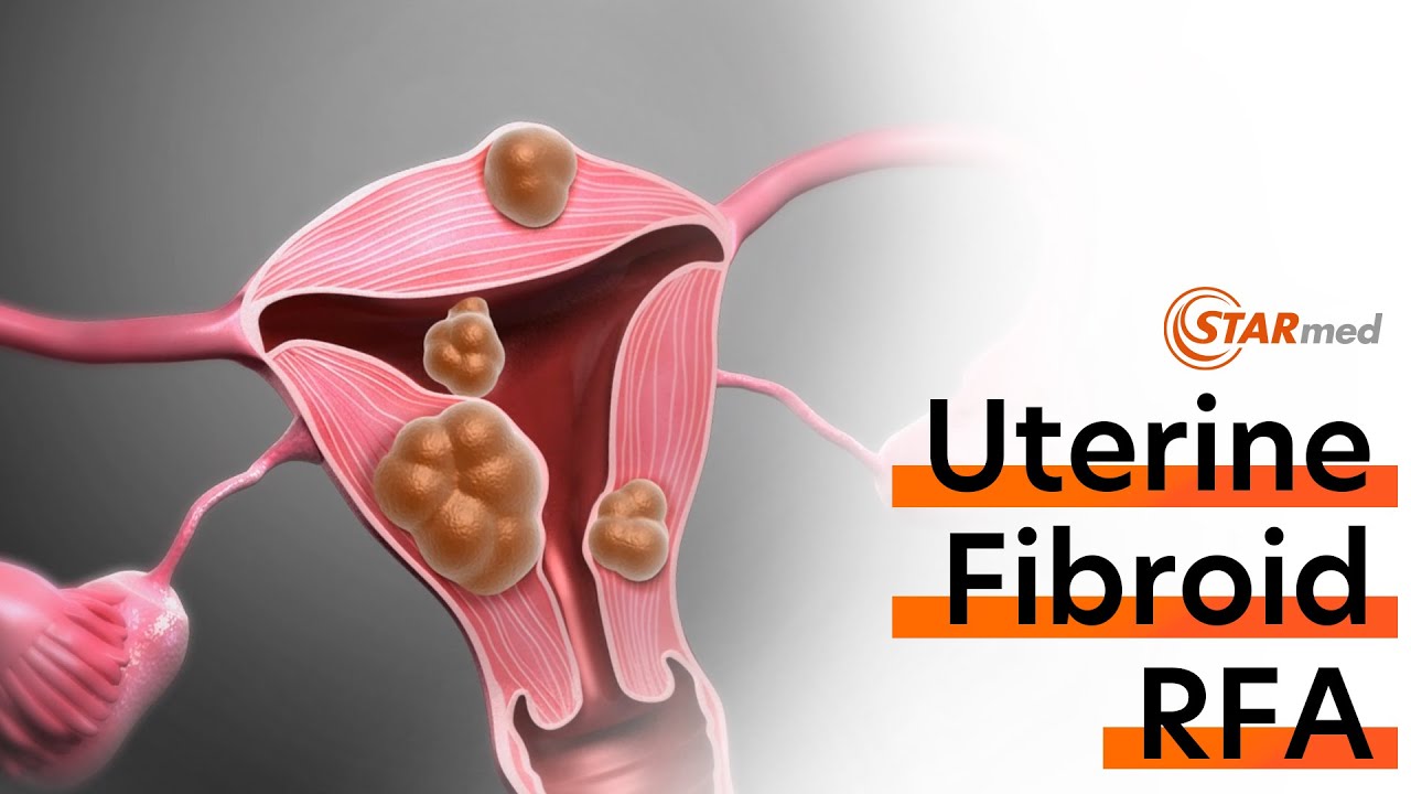 Uterine Fibroid Radiofrequency Ablation(RFA) Procedure