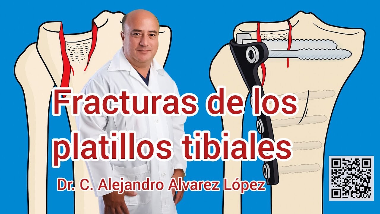 Fracturas de los platillos tibiales