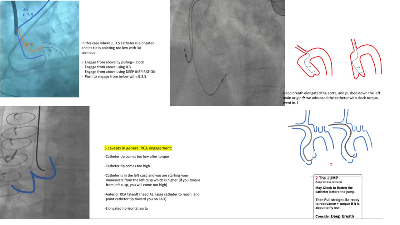Left+right coronary engagement for general fellows: step-by-step tips, diagrams, caveats (5 for RCA)