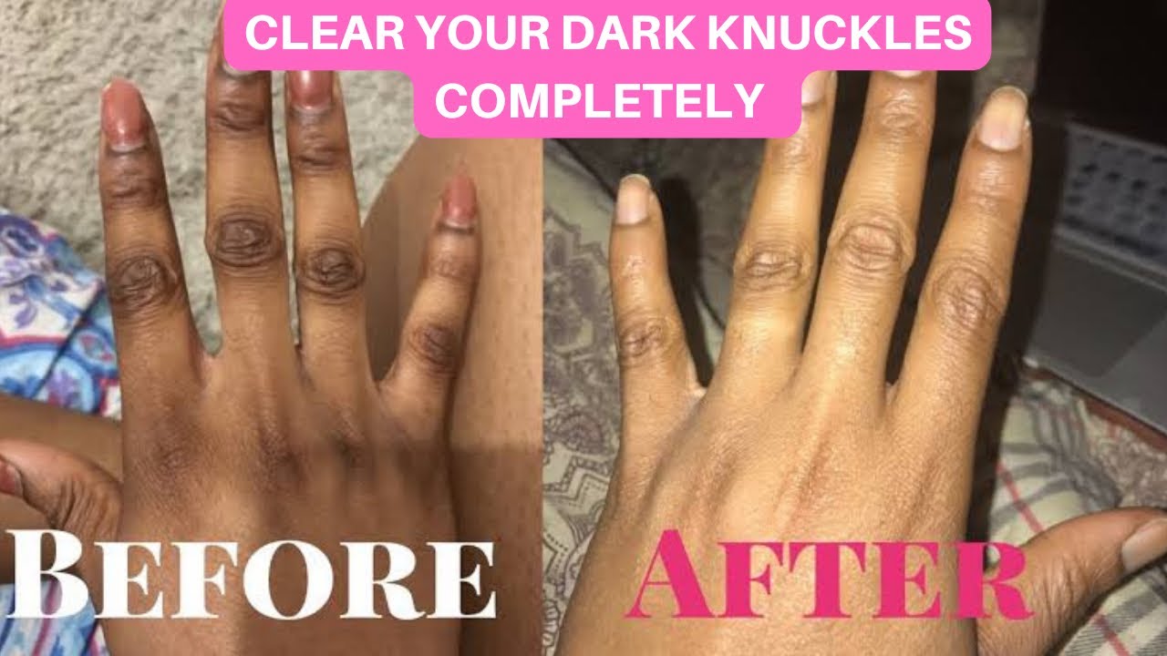 How to clear stubborn dark knuckles