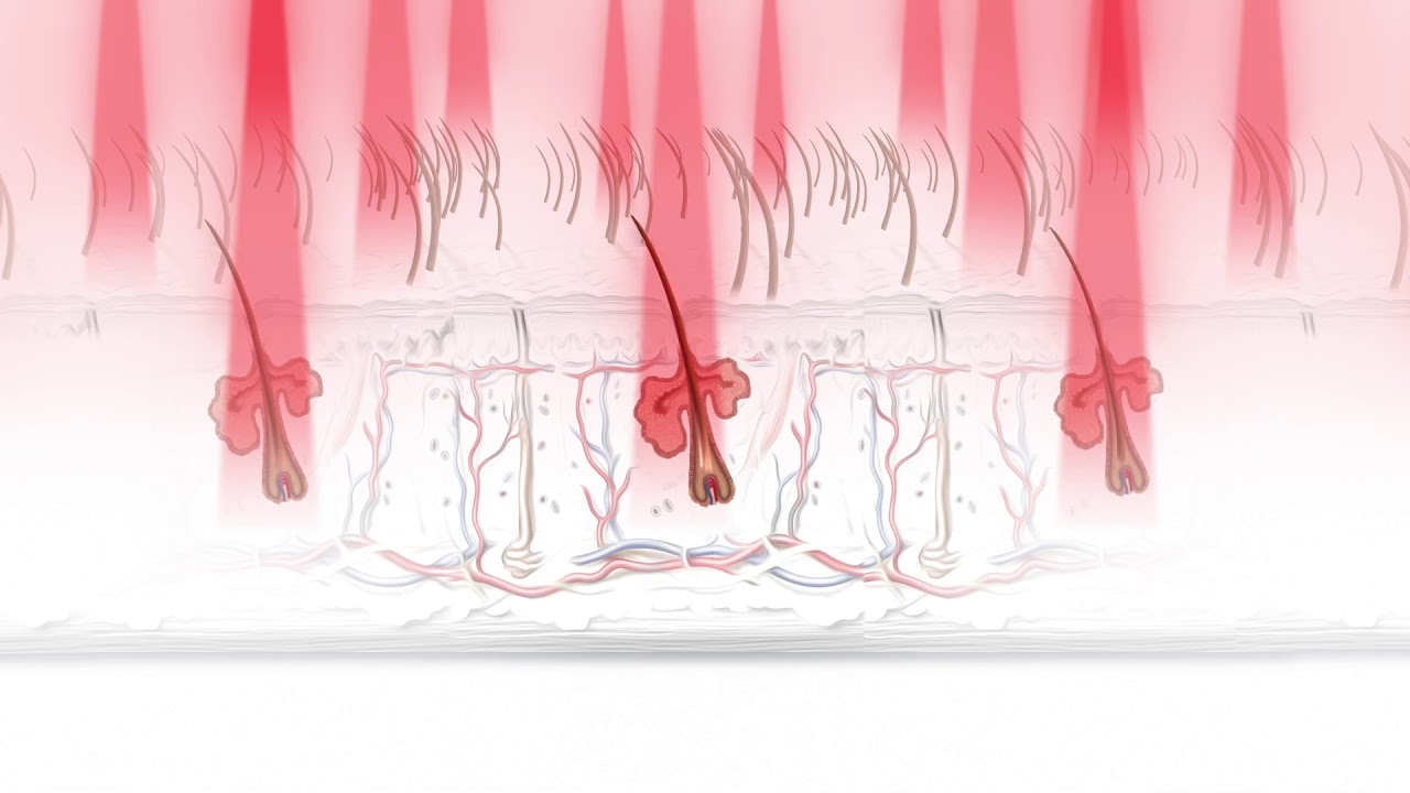 How Does Laser Help Hair Regrow?