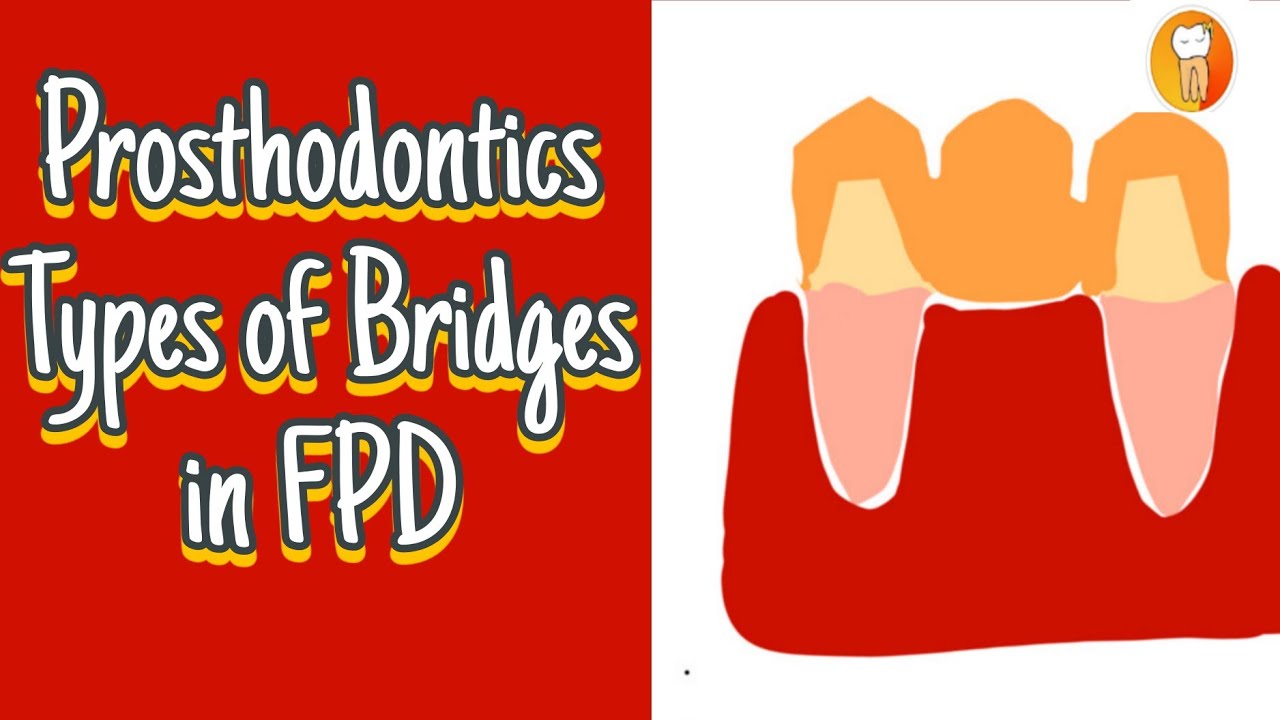 Prosthodontics 🔴Types of Bridges in fixed partial denture 🔴 fpd 🔴