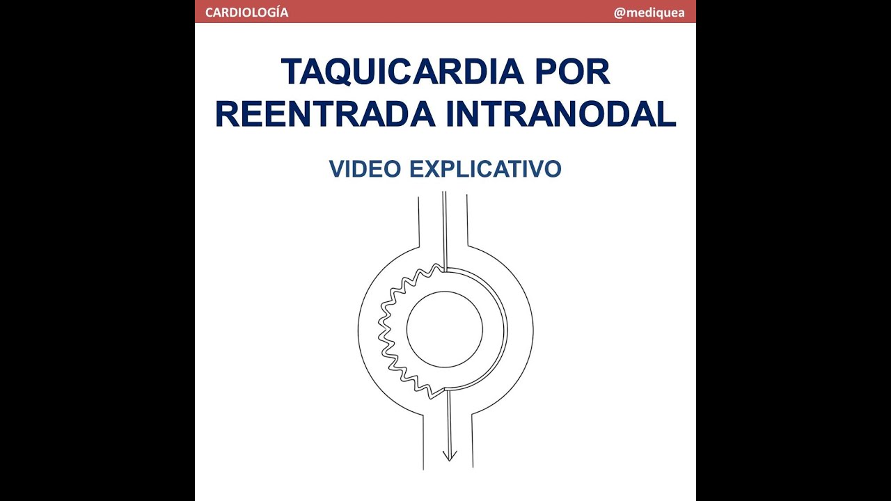 Taquicardia por Reentrada Intranodal (TRIN). Video explicativo