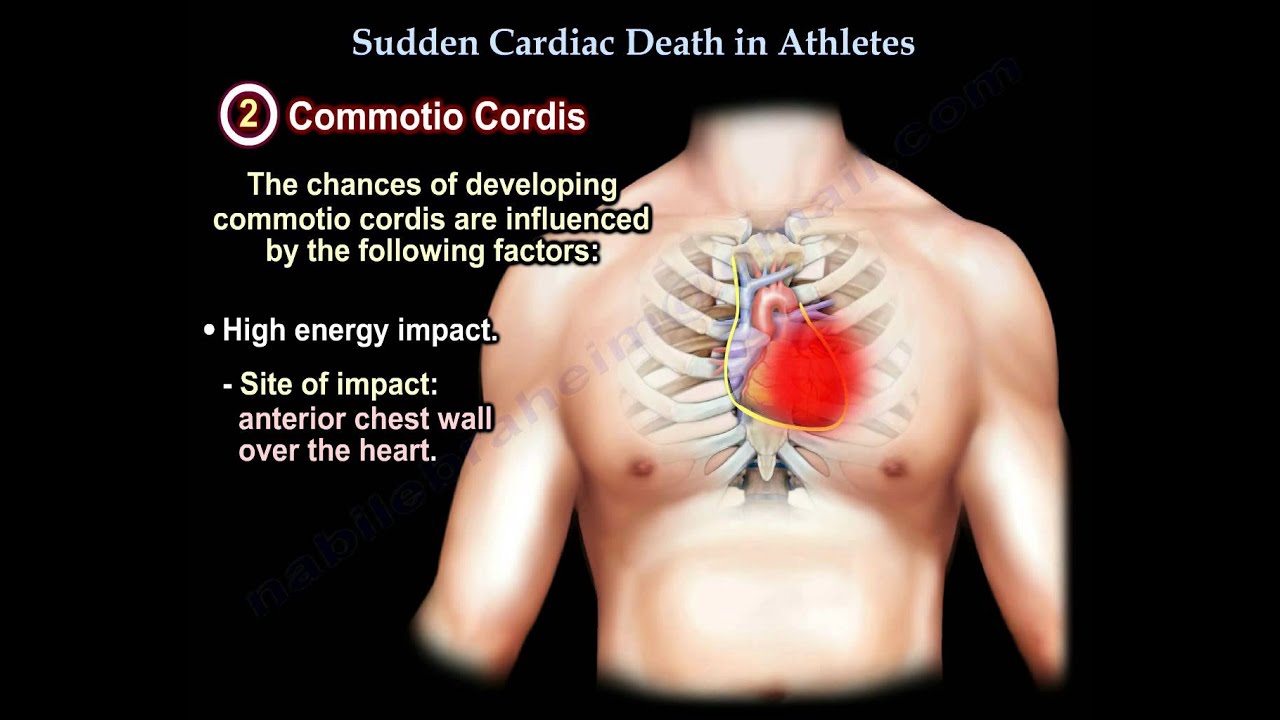 Sudden Cardiac Death In Athletes - Everything You Need To Know - Dr. Nabil Ebraheim