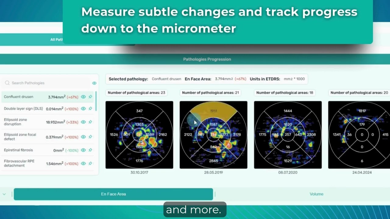 AI for Optometry: Decision Support for OCT Analysis