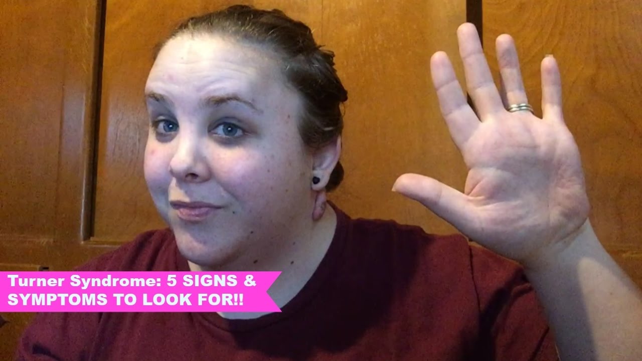 Turner Syndrome: 5 SIGNS AND SYMPTOMS TO LOOK FOR!!