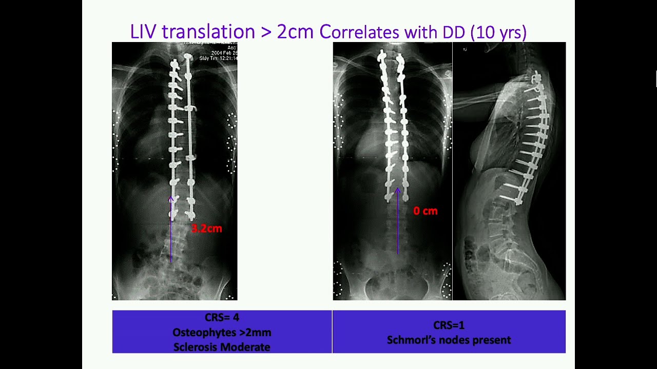 Operative Management of Thoracolumbar Scoliosis: Achieving Optimal Results with Lenke 5 and 6 Curves