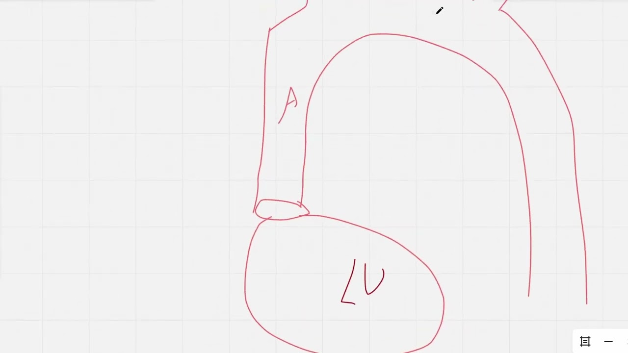 COMLEX & USMLE Practice Question 48 - Cardio - Unusual Causes of Near-Syncope