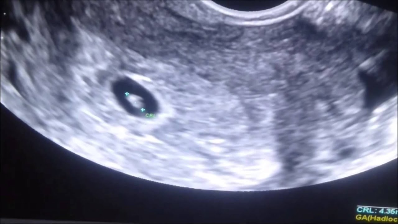 First Ultrasound - Baby has a Heartbeat!