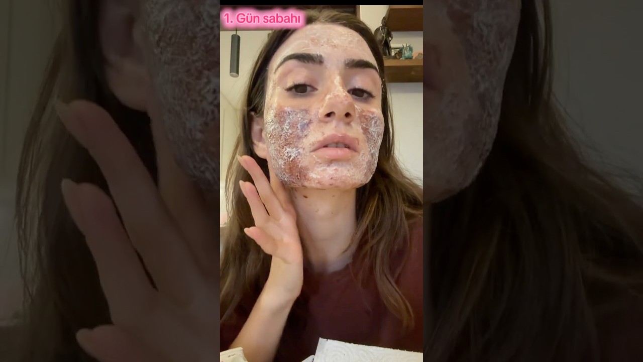 Full Ablatif Franksiyonel Lazer - Sivilce İzleri Nasıl ge&ccedil;er   #skar #fractionalco2laser