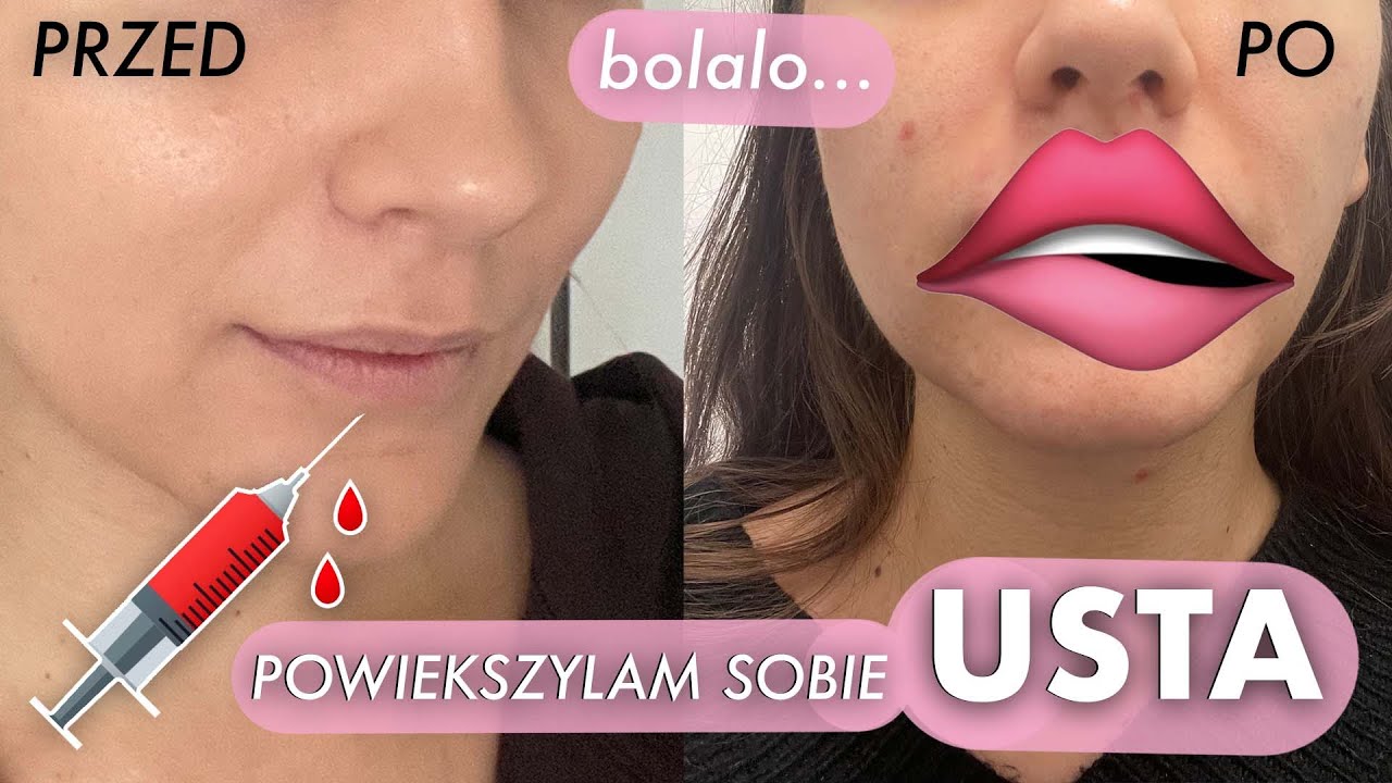 POWIĘKSZYŁAM SOBIE USTA! 👄😱 przed i po | cena | moje wrażenia