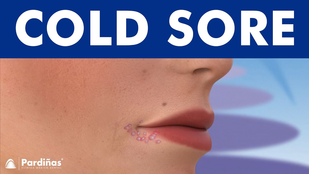 COLD SORES -  Causes and symptoms of herpes on lip &copy; (8K)