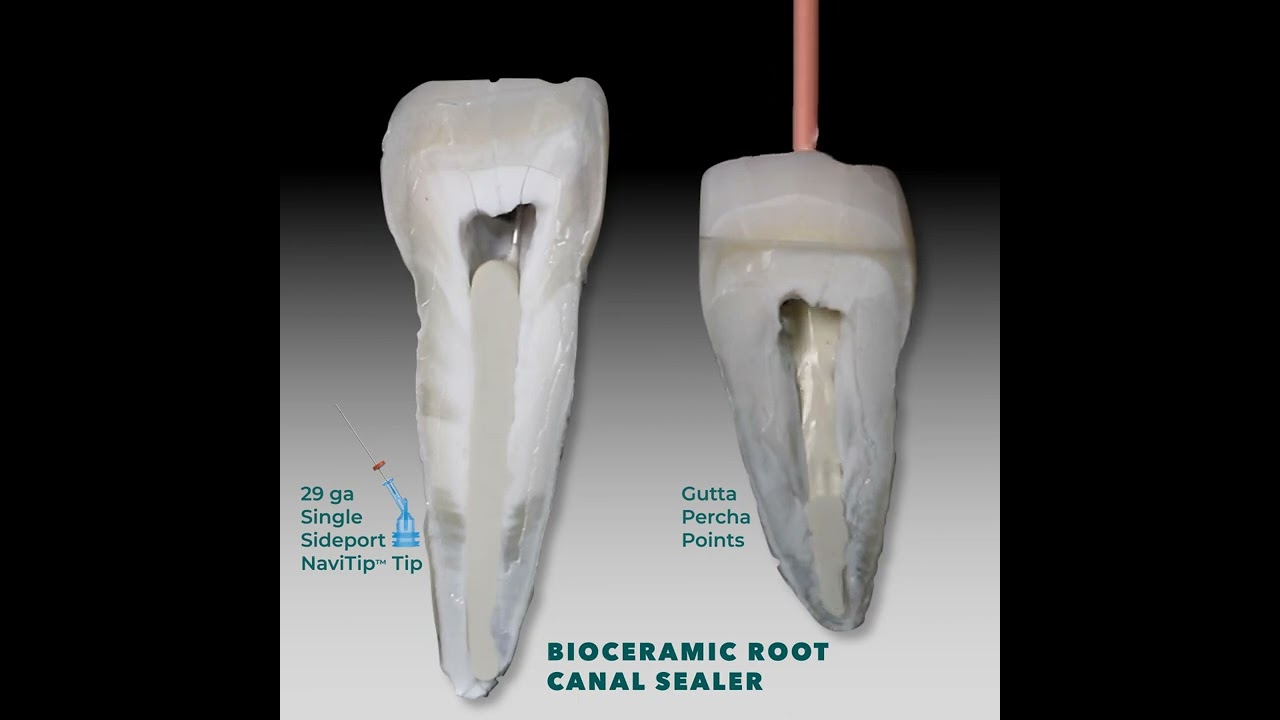 Delivering MTApex&trade; bioceramic root canal sealer