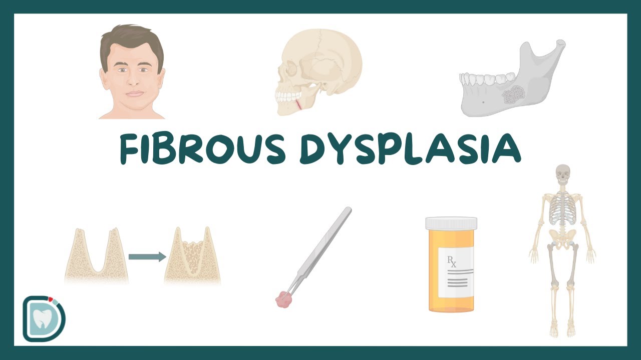 Understanding Fibrous Dysplasia: Causes, Diagnosis, Types, and Management