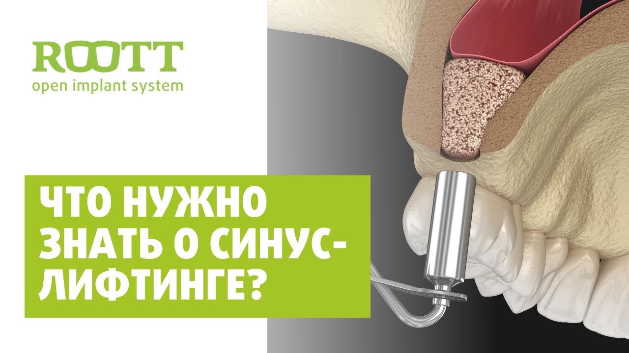 Синус лифтинг. Как делается? Операция синус лифтинга при имплантации зубов.