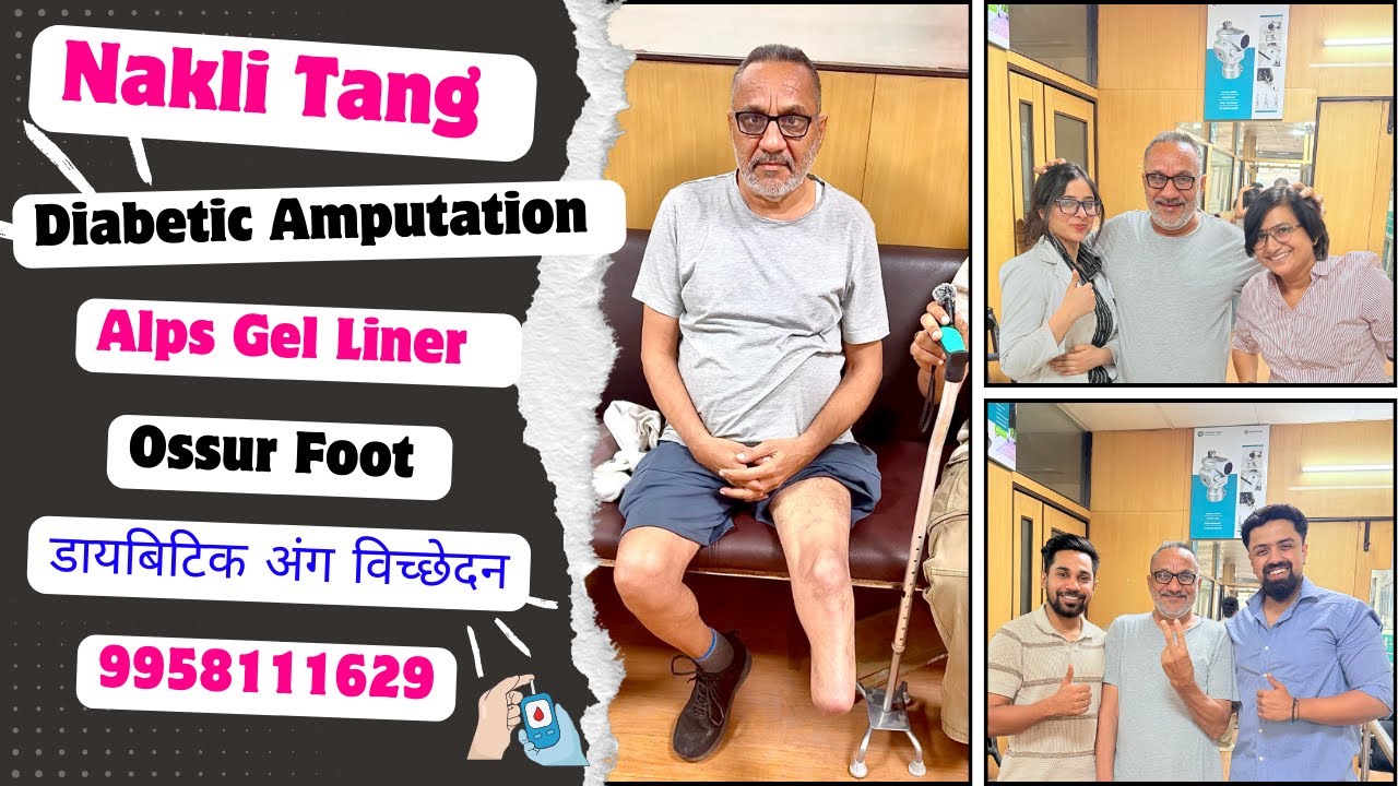 🥵😱Diabetic Amputation | Alps Gel Liner | Cusion Liner | Nakli Tang | Amputation in Delhi | #ossur