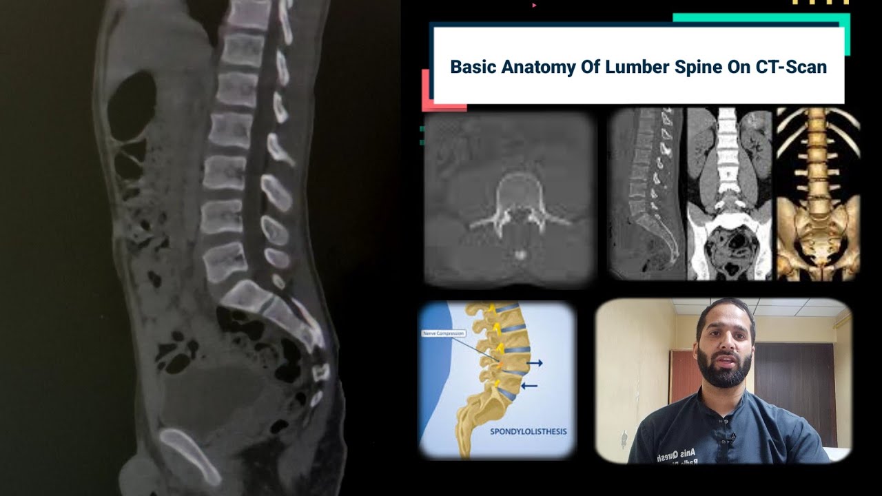 Basic Anatomy of Lumber Spine | CT Scan | By Anis Qureshi