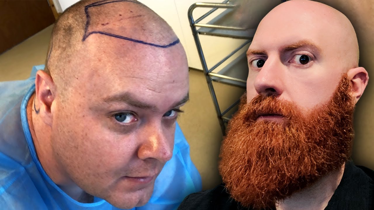 Should I Get a Hair Transplant? | Xeno Reacts to Preach's Hair Transplant