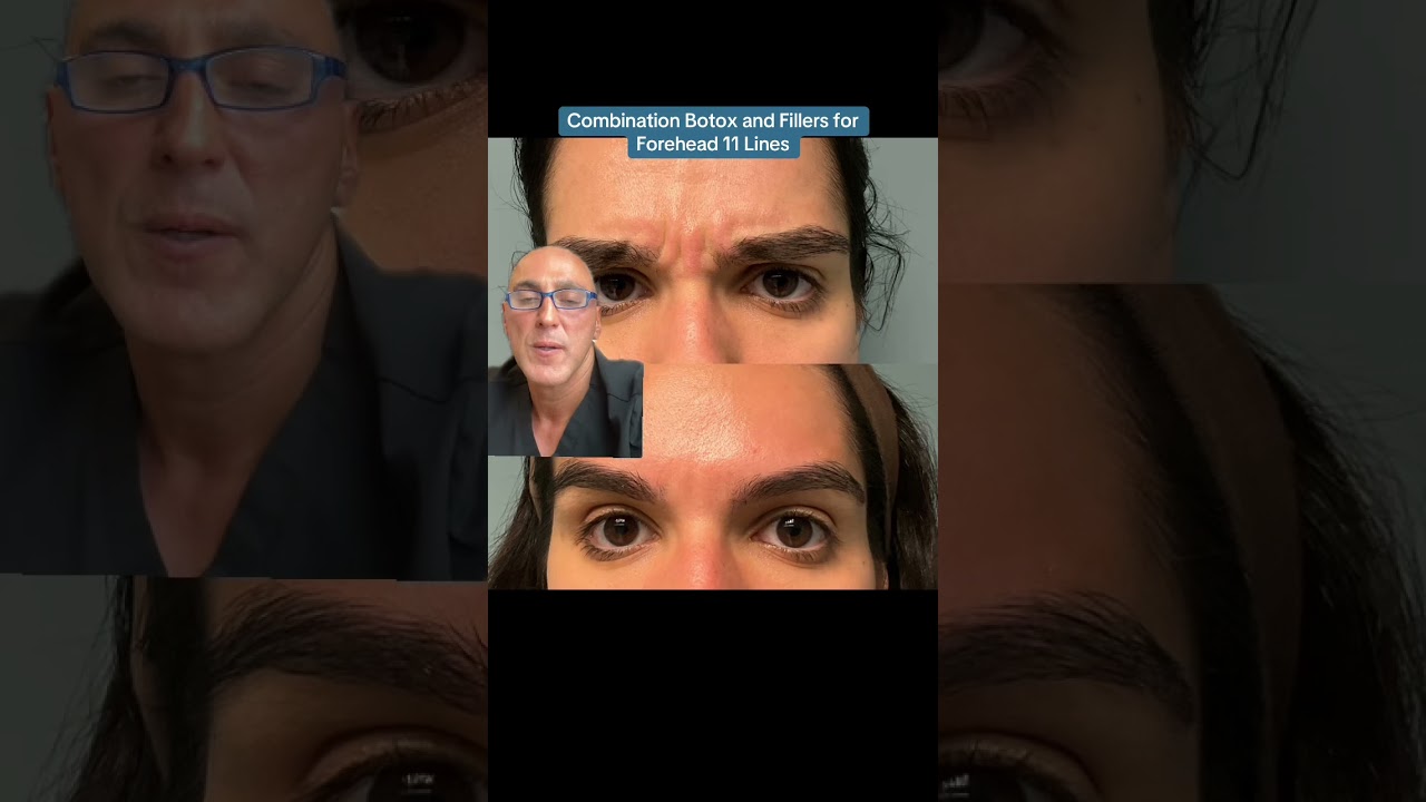 Combination Botox and Fillers for Forehead 11 Lines 