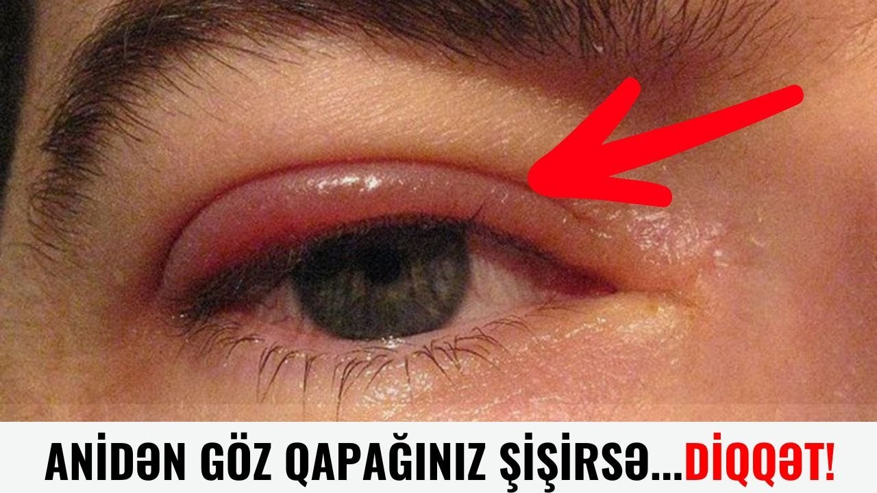 G&ouml;z qapaqlarınız anidən şişirsə...DİQQƏT!