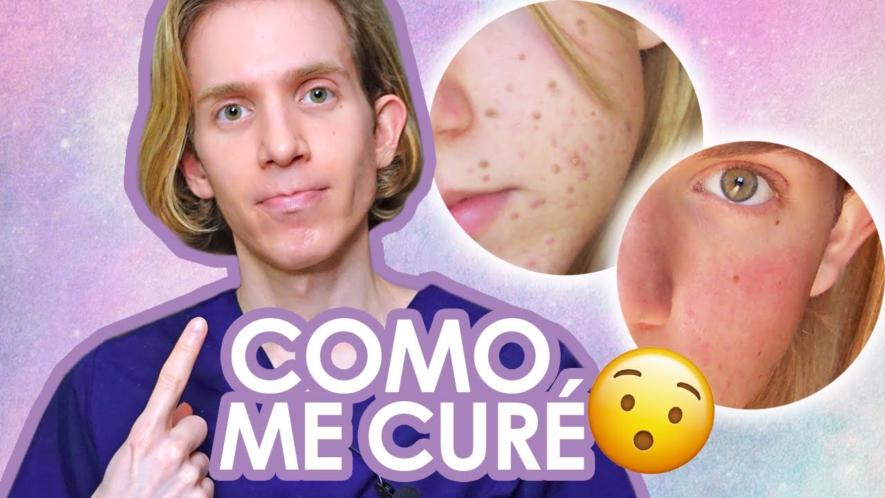 YO SUFRI DE ACNE : Mi experiencia y como me curé - Recomendaciones, consejos y mas