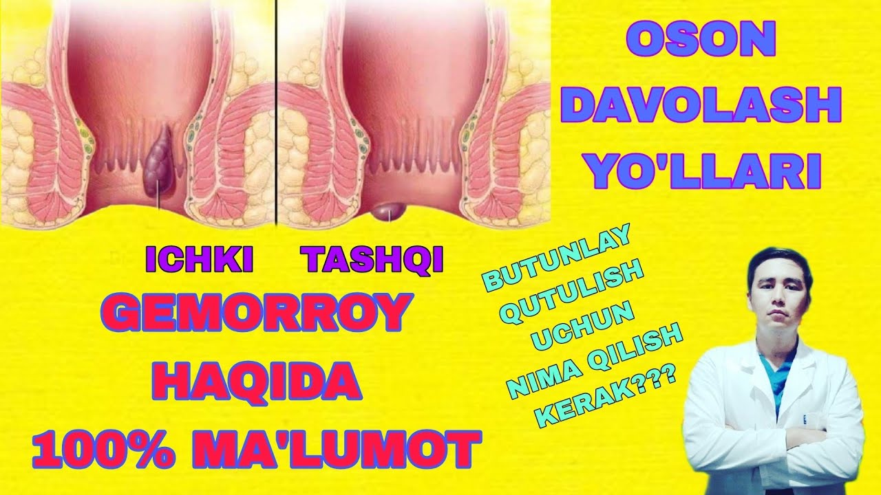 Gemorroy (Bavosil) kasalligi haqida 100% ma'lumot / Davolashning oson yoʻllari / Zamonaviy usullari