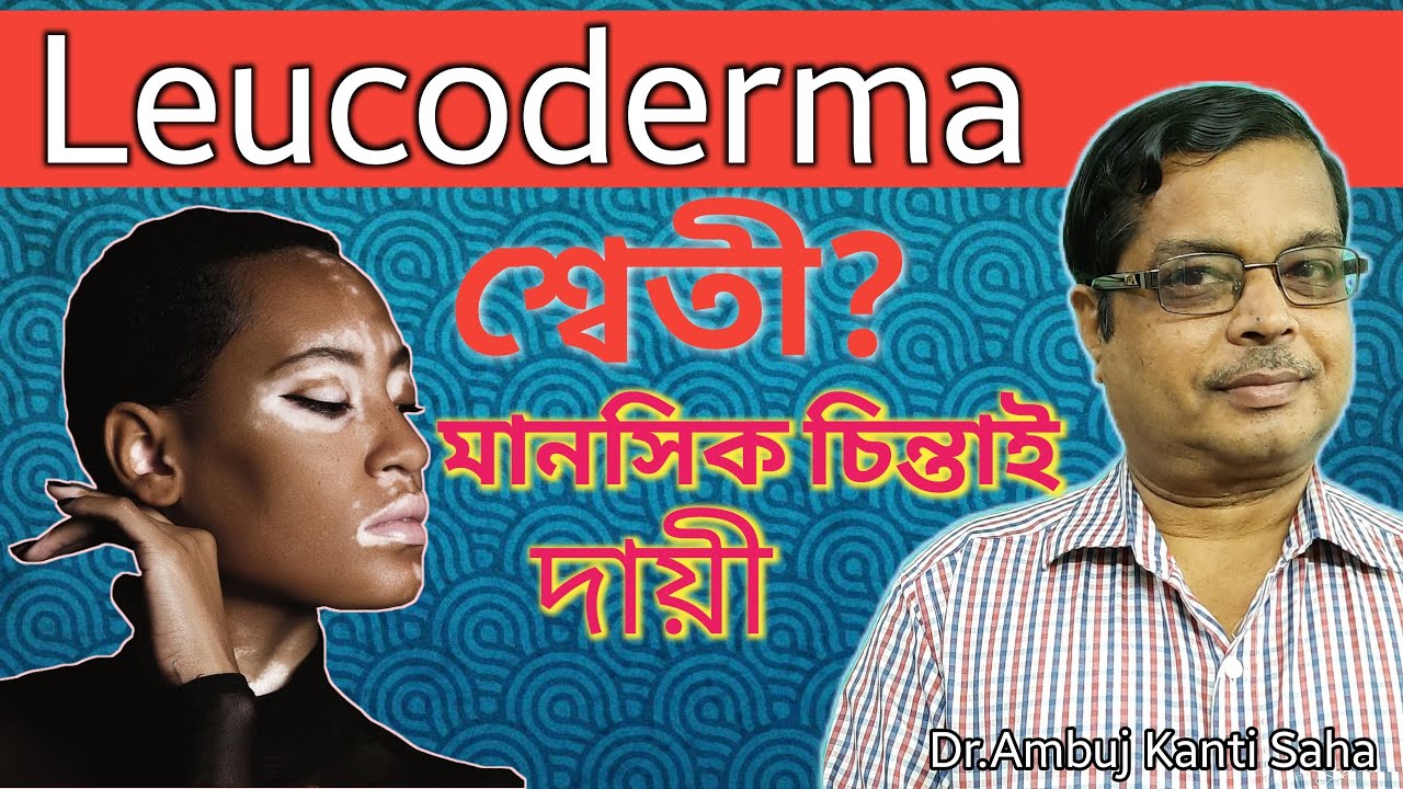 What is Vitiligo/Leucoderma? Is it curable? | Treat White Spot শ্বেতী From Root |শ্বেতী কী? কেন হয়?
