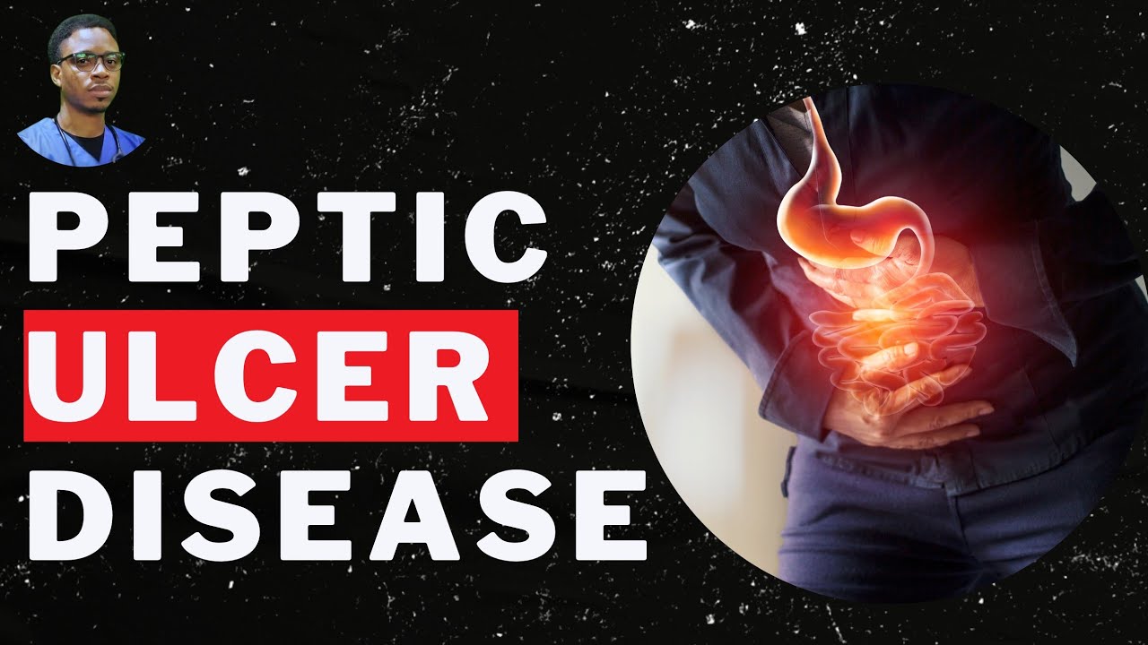 Understand The Causes Of Peptic Ulcer Disease - #doctorfredostar #hpylori #goodlifenasense