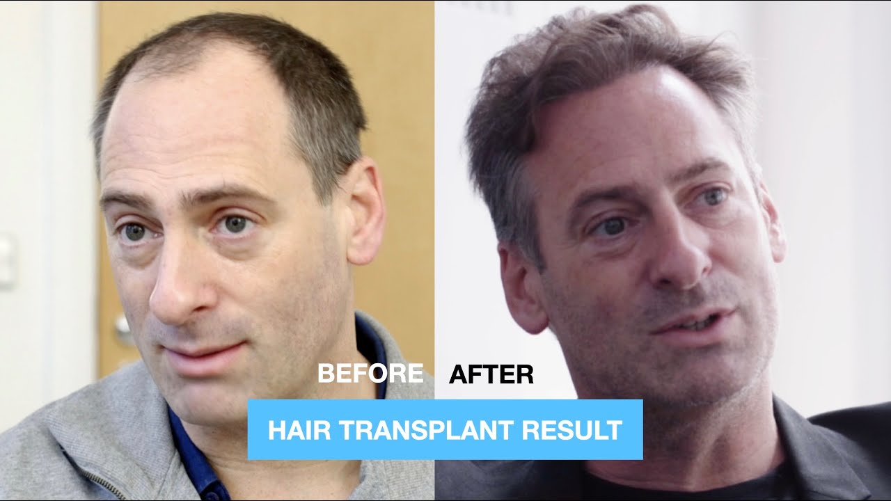 Andrew's FUE hair transplant result