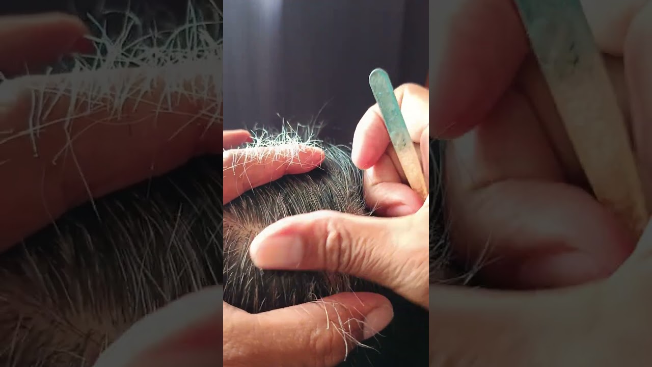 Most satisfying white hair removal 1.12#satisfying #relaxing #stressremoval