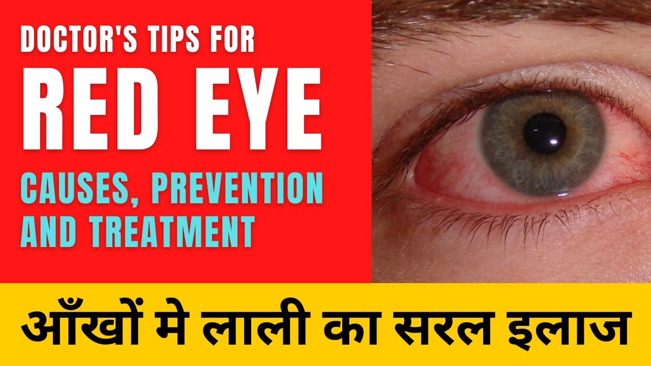Causes, Symptoms & Treatment of conjunctivitis | Treat Red Eye at home आँखों मे लाली का सरल इलाज