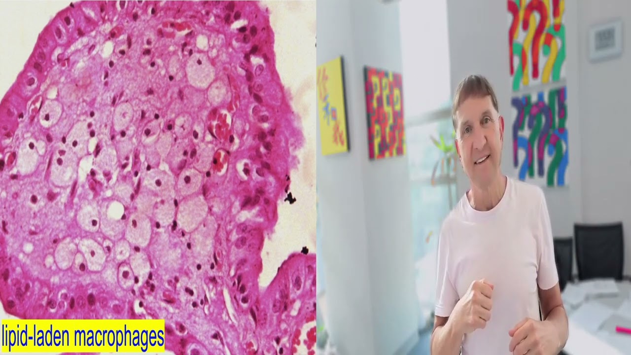 Genesis of Atherosclerosis.  A personal tale.