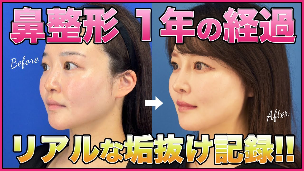 【全顔モニター】鼻フルコース×貴族手術で中顔面陥没を解消！本音語る1年の変化。