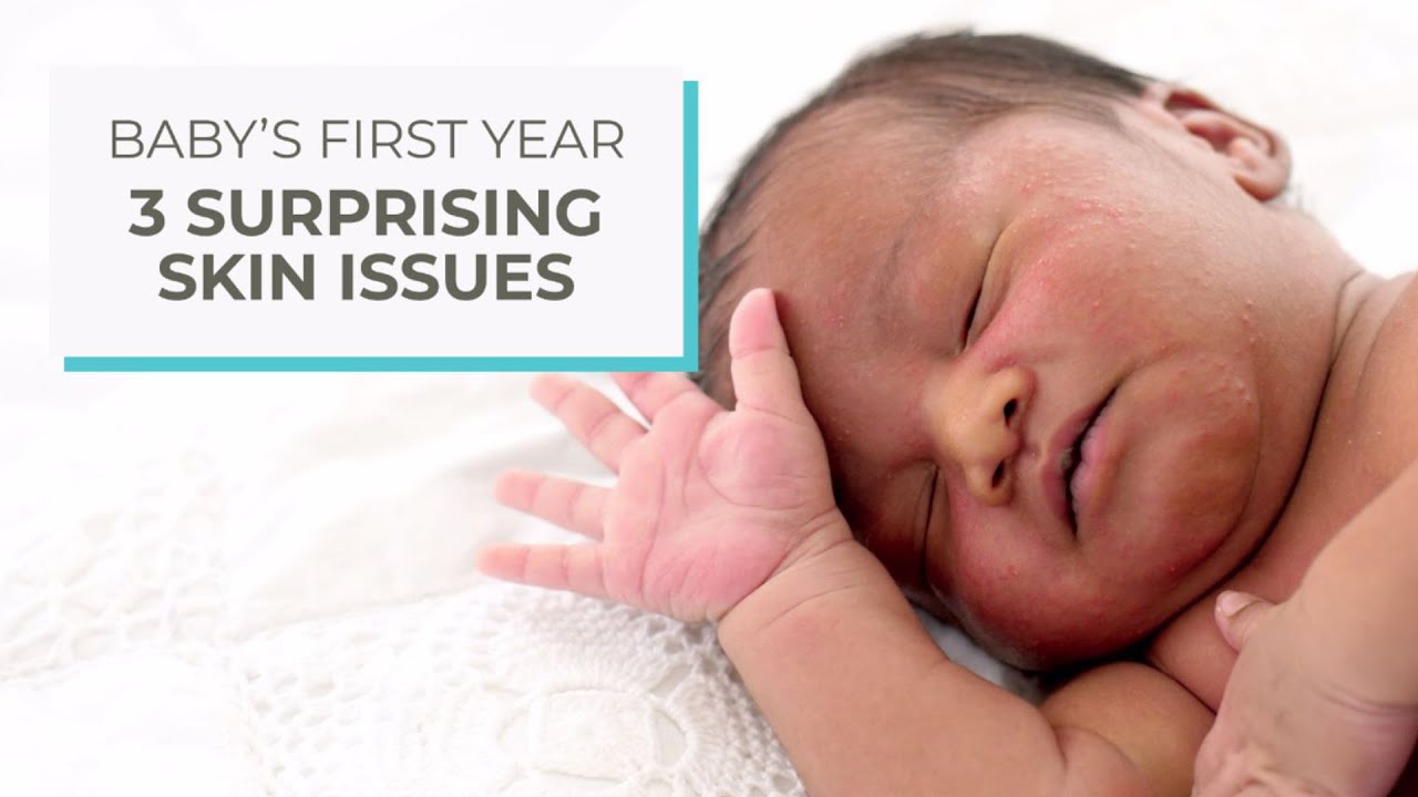 3 surprising skin issues | Ad Content by Huggies