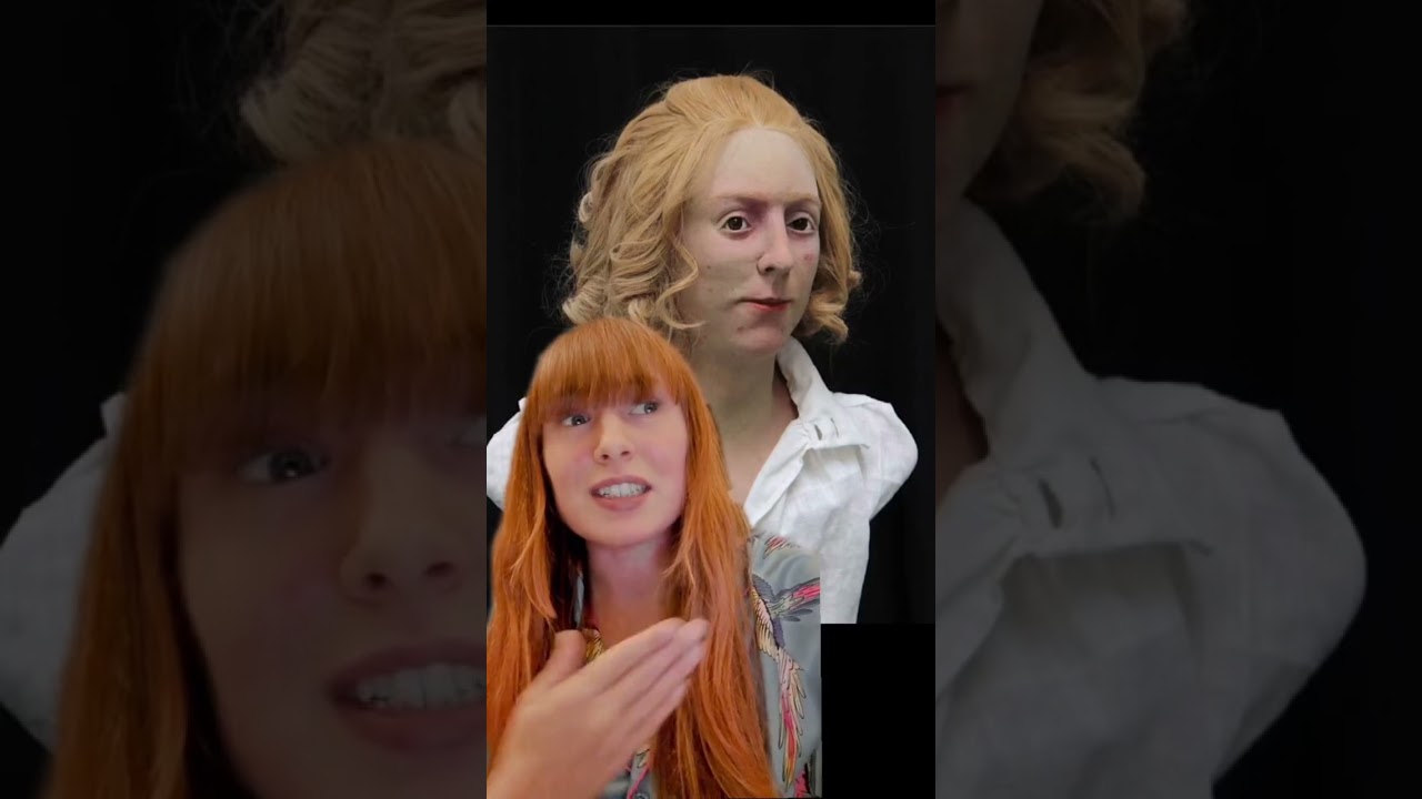 Bonnie Prince Charlie's acne 