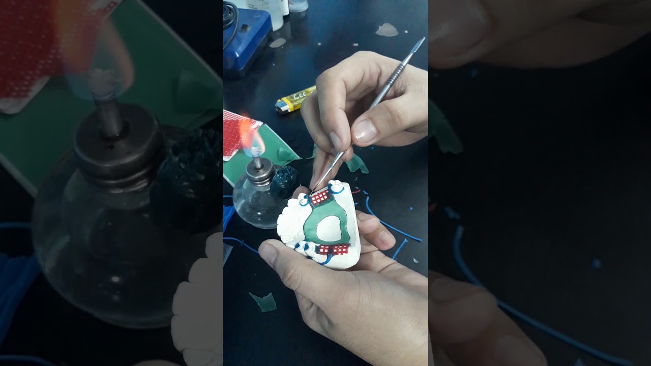 Wax pattern RPD (removable partial denture) 2/2