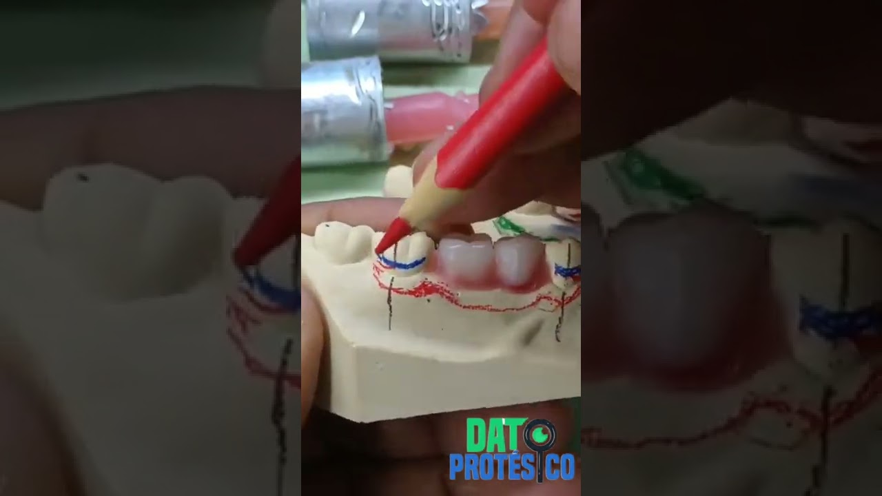 (PARTE 2). 🔎🧐 DEMOSTRACIÓN EN PROTESIS FLEXIBLE.♥️😍