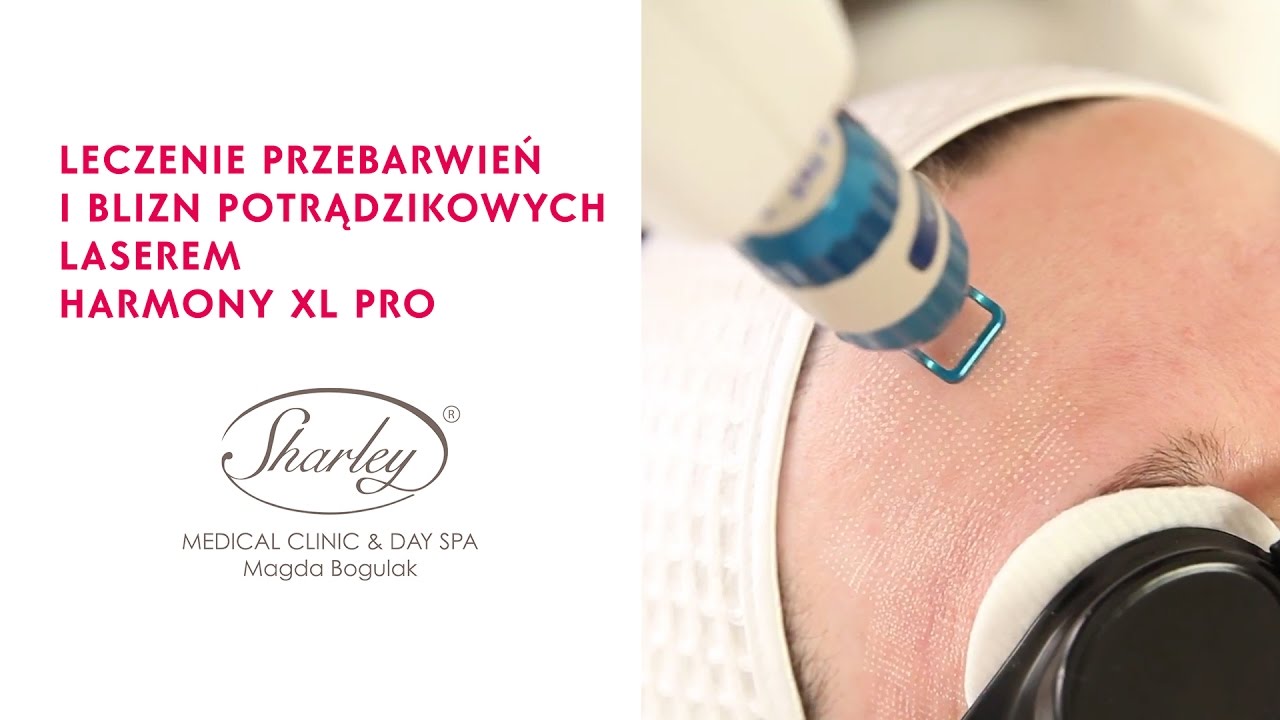 Leczenie blizn i przebarwień potrądzikowych, laser Alma Harmony XL PRO