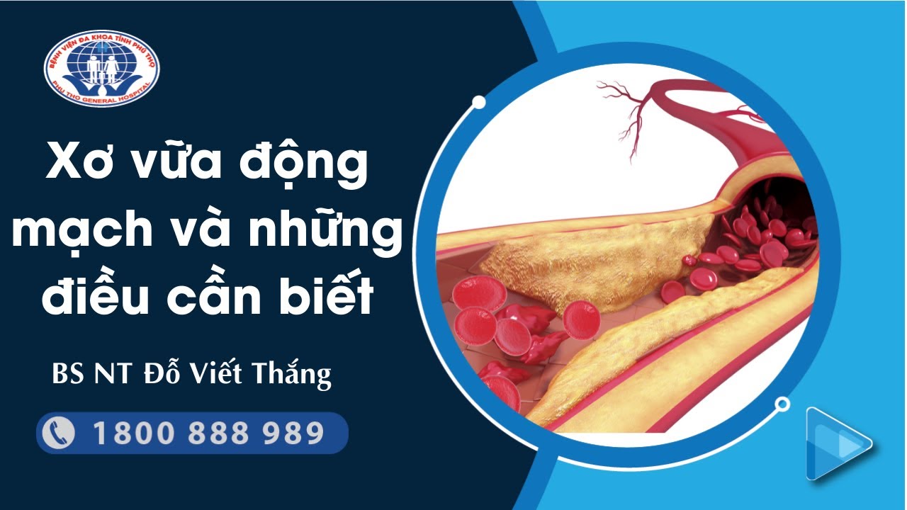 Xơ vữa động mạch - BS NT Đỗ Viết Thắng - Phó trưởng Đơn vị Can thiệp tim mạch - Trung tâm Tim mạch