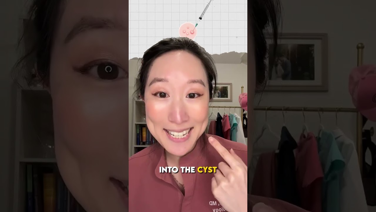 How to make an #acnecyst vanish in 24 hours! This is a great treatment for one off cysts