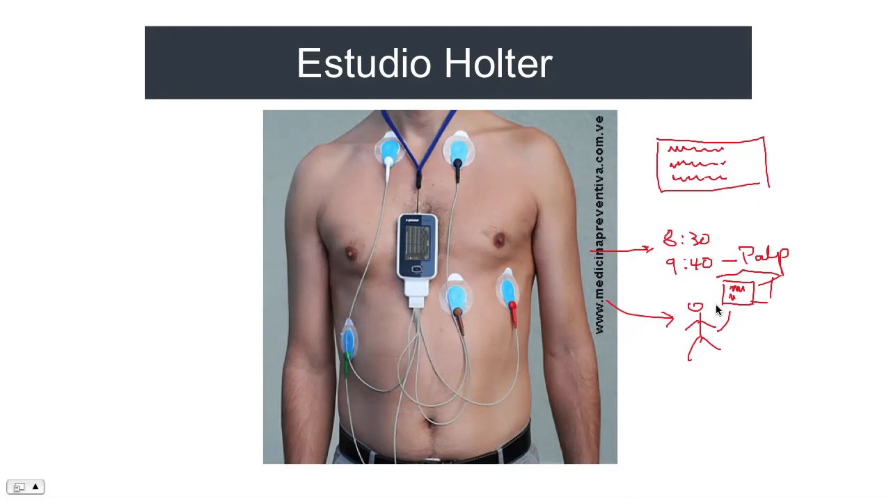Estudio de arritmias