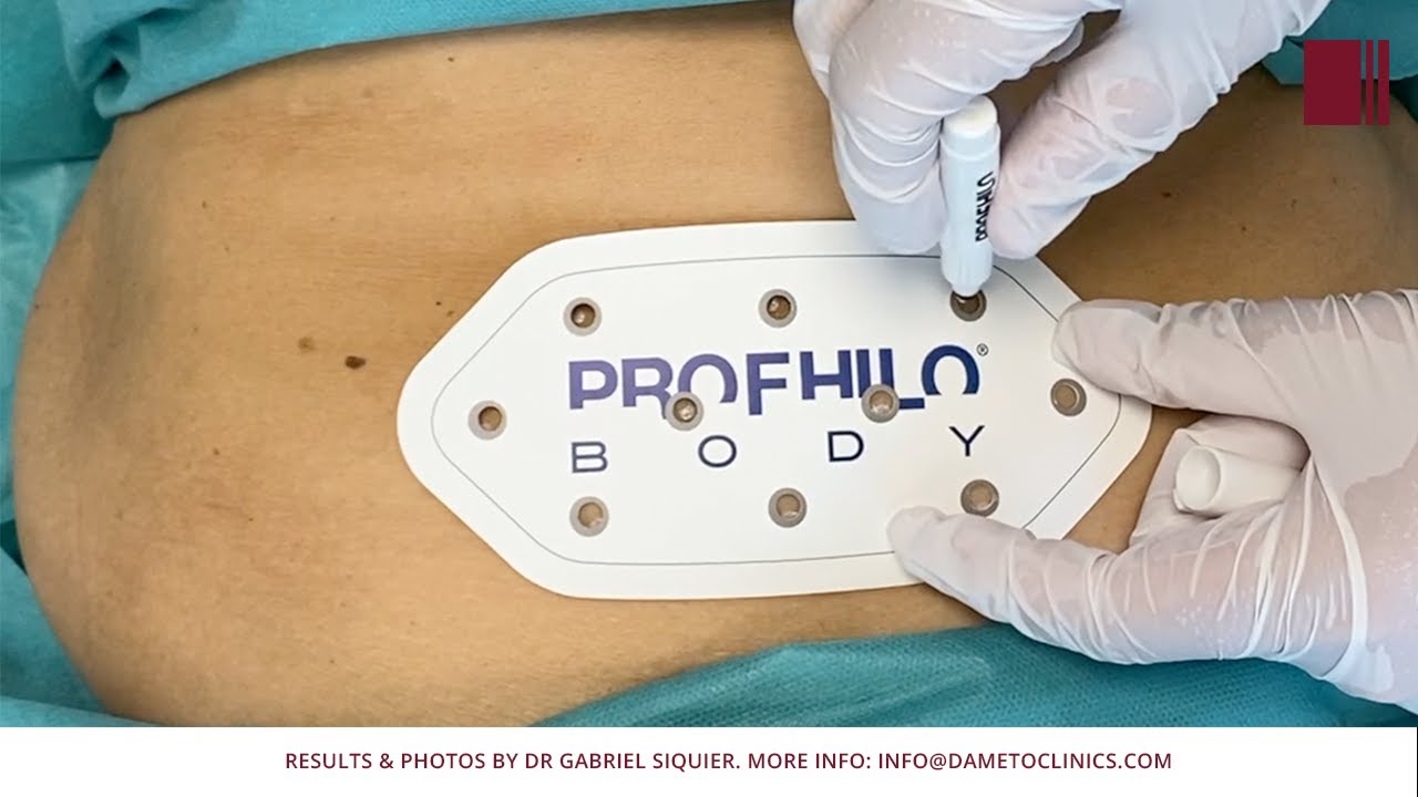 Profhilo Body abdomen by Dr Gabriel Siquier