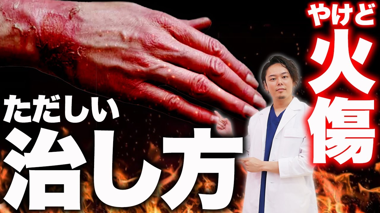 【元形成外科医が教える】火傷の種類と治し方【熱傷/やけど】